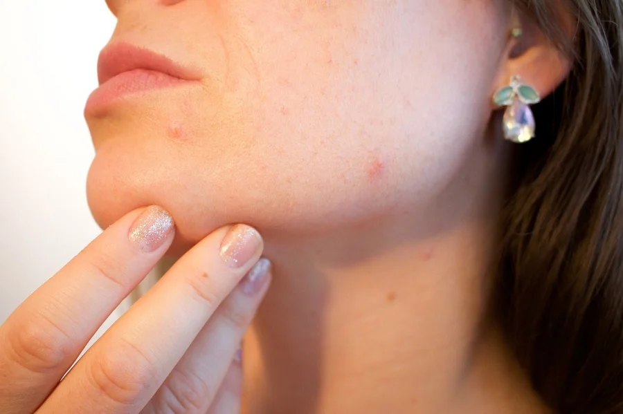 Traditional Medicine, Natural Treatments, and More for Checking Hormonal Acne Treatments Solution